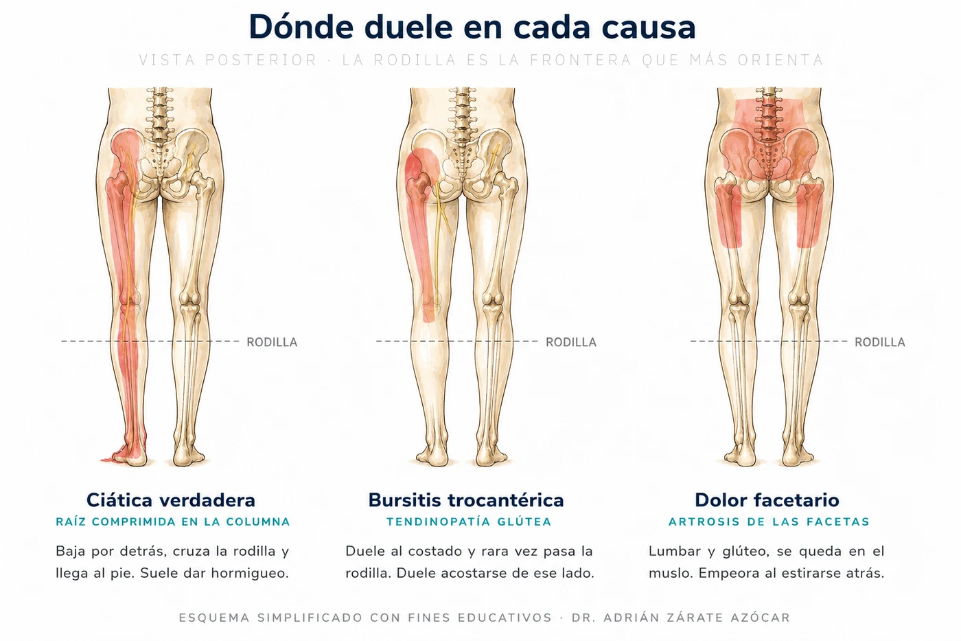 Comparación de la distribución del dolor en ciática verdadera, bursitis trocantérica y dolor facetario, en vista posterior