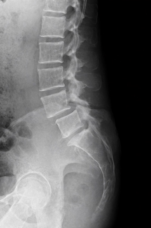 Espondilolistesis: Cuando una Vértebra se Desplaza de su Posición