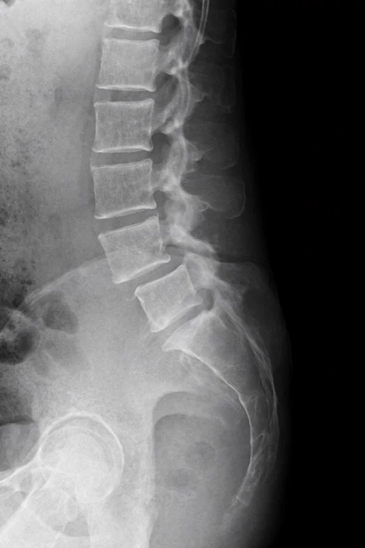 Espondilolistesis: Cuando una Vértebra se Desplaza de su Posición