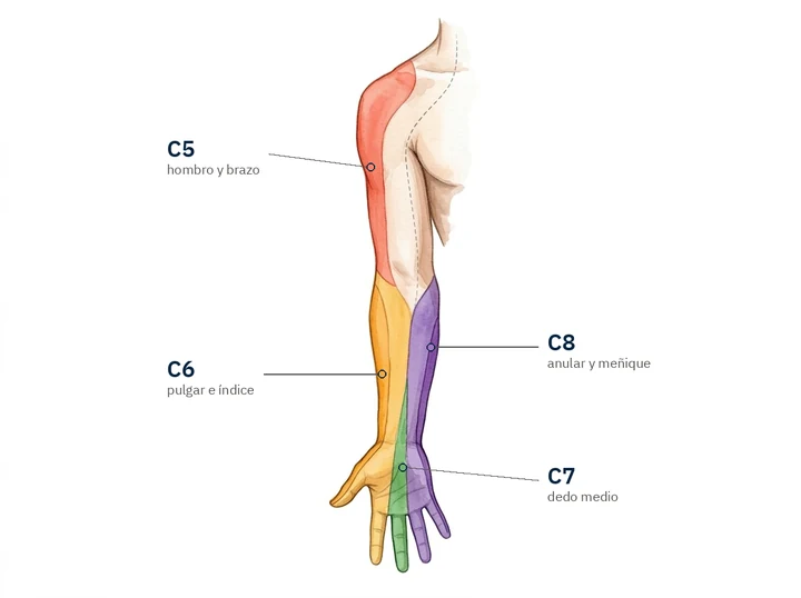 Brazo derecho con cuatro zonas de color: C5 en hombro y brazo, C6 en el borde externo del antebrazo, pulgar e índice, C7 en el dedo medio, C8 en el borde interno del antebrazo, anular y meñique