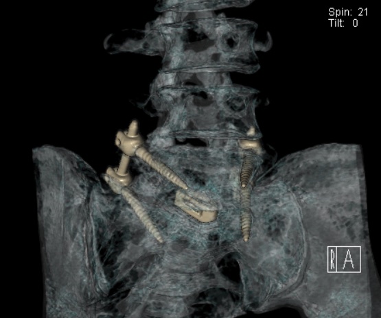 Reconstrucción tridimensional de tomografía de la columna lumbosacra de un paciente operado, con los tornillos de la fijación visibles dentro del hueso